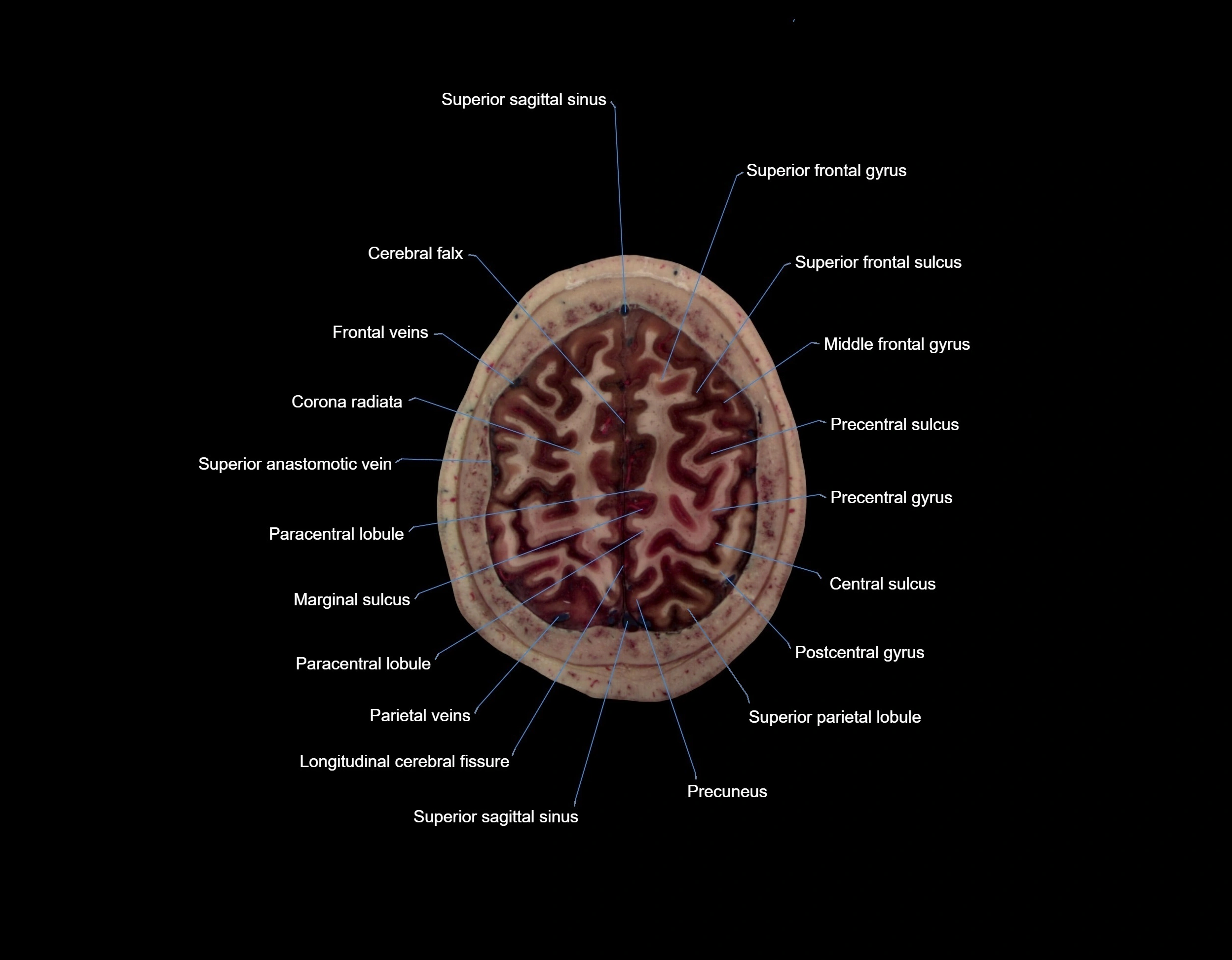 MRI Brain axial cross sectional radiology anatomy 3T image  -img-000065.webp